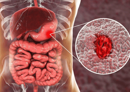 این افراد بیشتر به سرطان معده مبتلا می‌شوند