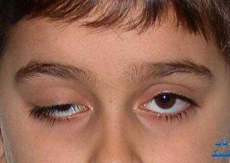علت افتادگی پلک چشم چیست و چطور درمان می‌شود؟