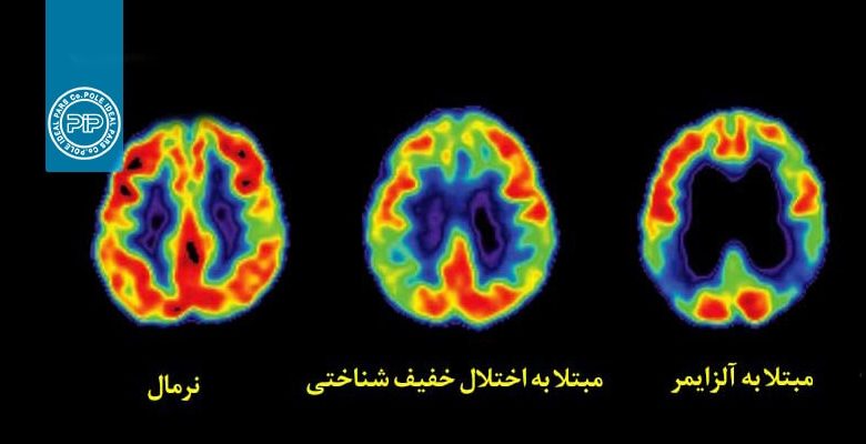 مغز+بدن+آلزایمر
