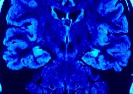 کشف جدید مغزی راز تقویت توانایی مبارزه با آلزایمر و ام‌اس را برملا کرد