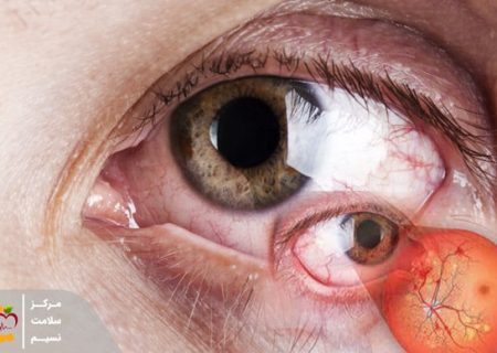 راه‌های جلوگیری از آسیب چشم ناشی از قند خون
