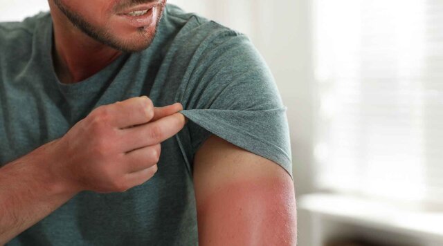 خطر بروز سرطان با آفتاب‌سوختگی/ توصیه‌هایی برای مراقبت از پوست در گرما