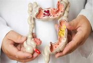 پولیپ روده چیست؟ بررسی علائم، دلایل، تشخیص و درمان