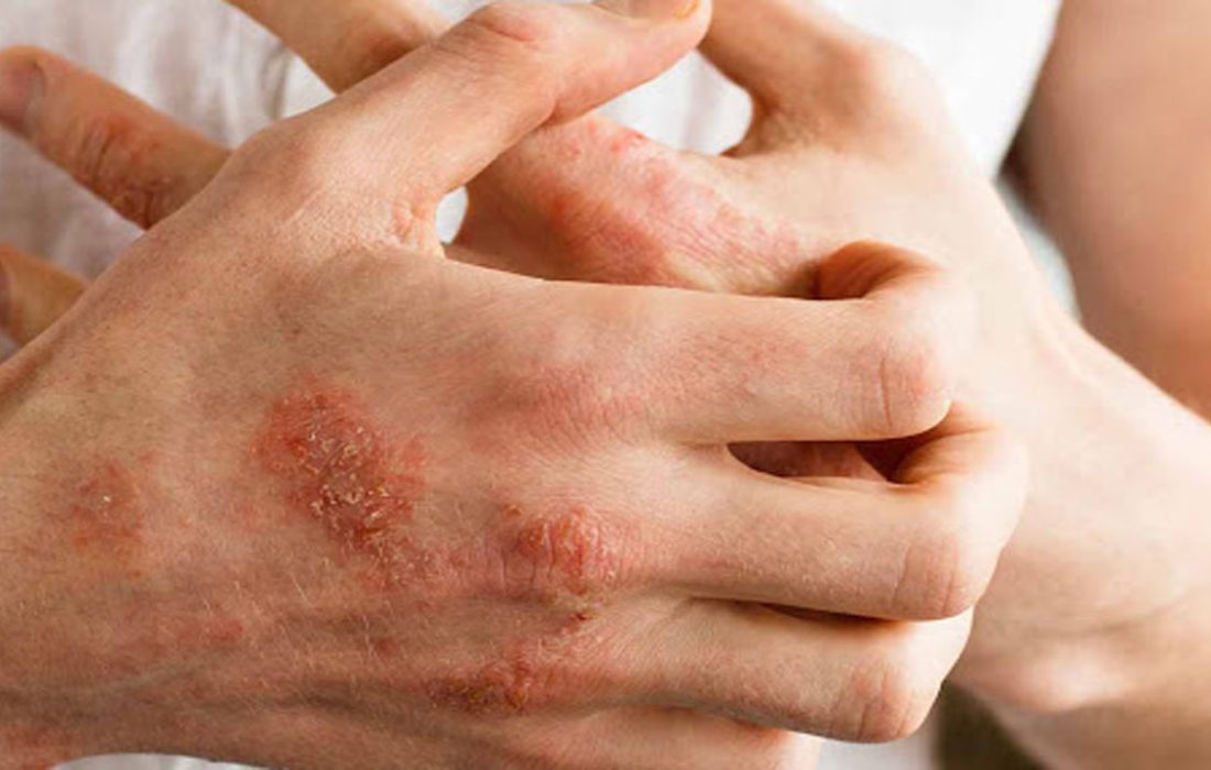 ۷ نشانه‌ پوستی که خبر از بیماری جدی می‌دهند