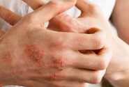 ۷ نشانه‌ پوستی که خبر از بیماری جدی می‌دهند