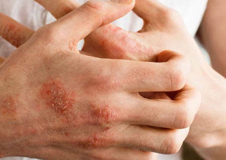 ۷ نشانه‌ پوستی که خبر از بیماری جدی می‌دهند