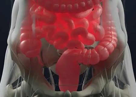 خونریزی گوارشی تحتانی؛ بواسیر یا سرطان؟