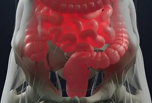 خونریزی گوارشی تحتانی؛ بواسیر یا سرطان؟
