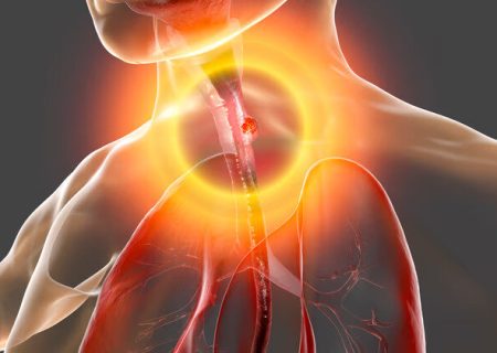 درباره سرطان مری؛ یک سرطان شایع در ایران