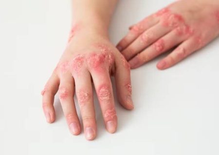 لوپوس، بیماری هزار چهره سیستم ایمنی را بشناسید